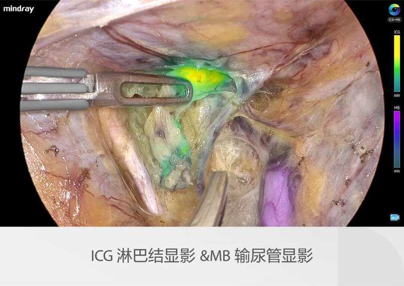  迈瑞全域荧光智能影像平台，开启精准外科新视野；多光谱融合，量化分析助力临床决策。 IT技术 迈瑞全域荧光智能影像平台，开启精准外科新视野；多光谱融合，量化分析助力临床决策。 IT技术 迈瑞全域荧光智能影像平台，开启精准外科新视野；多光谱融合，量化分析助力临床决策。 IT技术 迈瑞全域荧光智能影像平台，开启精准外科新视野；多光谱融合，量化分析助力临床决策。 IT技术