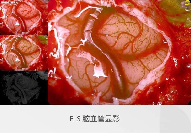  迈瑞全域荧光智能影像平台，开启精准外科新视野；多光谱融合，量化分析助力临床决策。 IT技术 迈瑞全域荧光智能影像平台，开启精准外科新视野；多光谱融合，量化分析助力临床决策。 IT技术 迈瑞全域荧光智能影像平台，开启精准外科新视野；多光谱融合，量化分析助力临床决策。 IT技术 迈瑞全域荧光智能影像平台，开启精准外科新视野；多光谱融合，量化分析助力临床决策。 IT技术